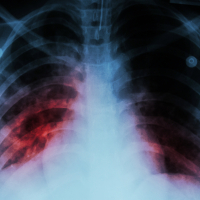 Röntgenbild einer mit Tuberkuloseviren befallenen Lunge